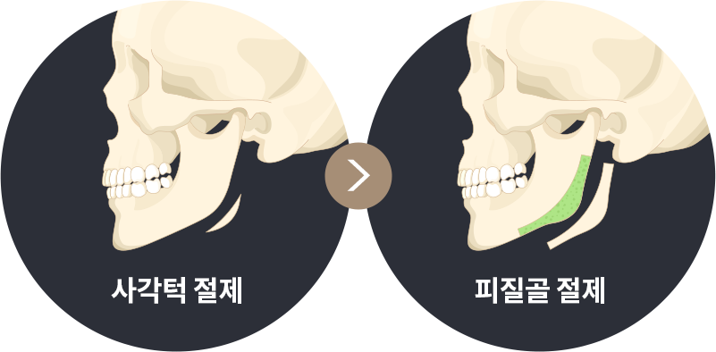 사각턱수술 이미지